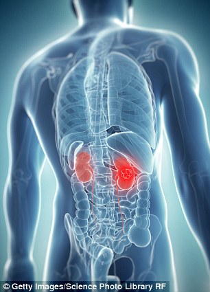 New hope for kidney cancer sufferers as scientists reveal a 'breakthrough' combination of drugs has the potential to clear tumours from patients